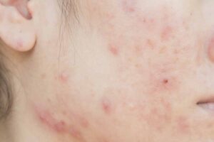 Acne vulgaris vanwege een vitamine A tekort